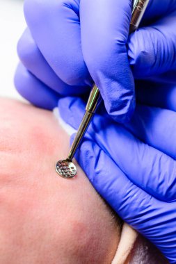 Mekanik yüz temizleme, yüzeyden cilt temizleme prosedürü ve derin kirlilik. yeni