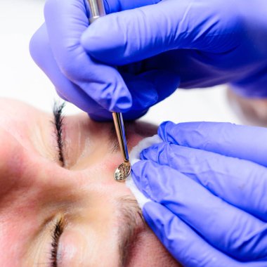 Kaşıkla yüzün mekanik olarak temizlenmesi, yağ ve siyah noktaların çıkarılması. yeni