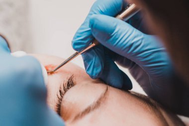 Yüz milisleri, kozmetolojide bir şırıngayla milislerin çıkarılması. yeni