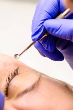 Yüz milisleri, kozmetolojide bir şırıngayla milislerin çıkarılması. yeni