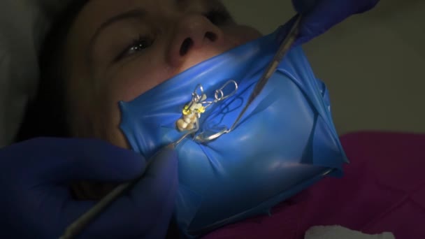 Zahnarzt in medizinischen Handschuhen mit einem UV-Gerät in der Hand arbeitet mit dem Patienten zusammen und härtet die Füllung des Zahnes aus. — Stockvideo