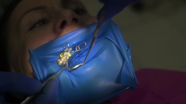 Attrezzature moderne in una clinica dentale, sigillatura dei canali, rilevatore di carie ultraviolette. — Video Stock