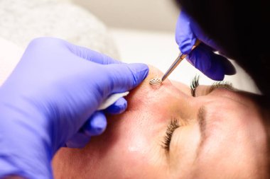 Kaşıkla yüzün mekanik olarak temizlenmesi, yağ ve siyah noktaların çıkarılması. yeni