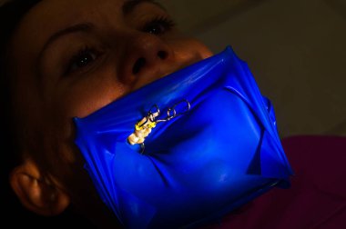 Diş prosedürü, üst masticatory diş tedavisi, kauçuk barajla modern diş tedavisi. yeni