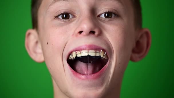 Стоматологическая пластина для выравнивания зубов во рту, ребенок носит зубную пластину для коррекции и выравнивания зубов. — стоковое видео