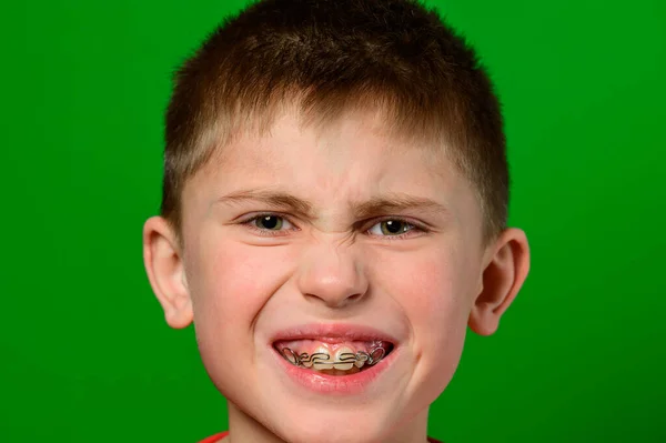 Мальчик Кавказского Происхождения Демонстрирует Пластину Выпрямления Кривых Искаженных Зубов Новый — стоковое фото