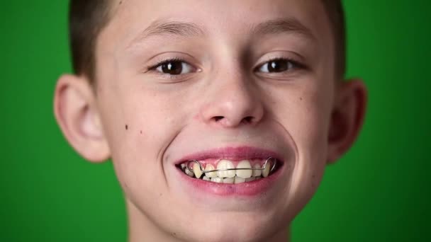 Glimlach baby, jongen draagt een bord voor het uitlijnen van tanden, tandheelkundige zorg. — Stockvideo