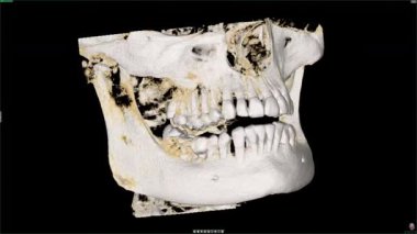 Diş MR yazılımı ekranının animasyonu. Kafatası taraması yaparak diş sağlığını izliyoruz. Diş muayenesi. Diş implantı yerleştirme
