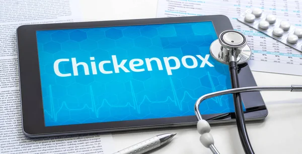 Word Chickenpox Display Tablet — Stock Photo, Image