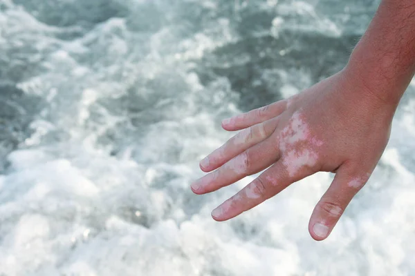 Vitiligo Hand Sea Background — Stock Photo, Image