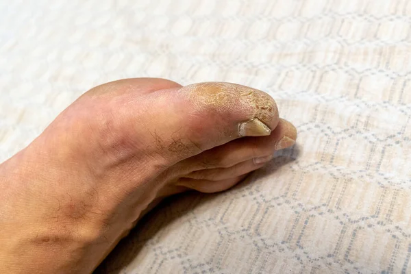 Unkempt Пальцы Ноги Человека Которые Требуют Педикюр — стоковое фото