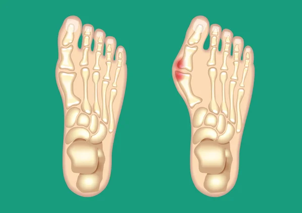 Schematische tekening van een Bunion — Stockvector