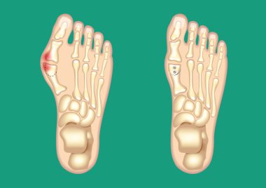 Bunion2 şişik çizim şematik