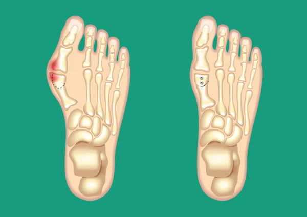 Bunion2 Схематический рисунок bunion — стоковый вектор