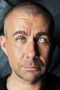 Şaşılık. Şaşılık olan bir adam.