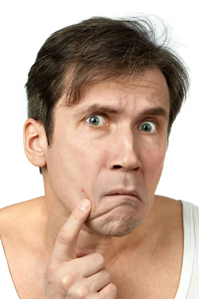 Men squeezing a pimple — Stock Photo, Image