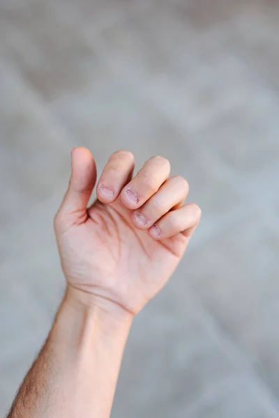 Mão Homem Com Unhas Mordidas Feias Mau Cuidado Das Mãos — Fotografia de Stock