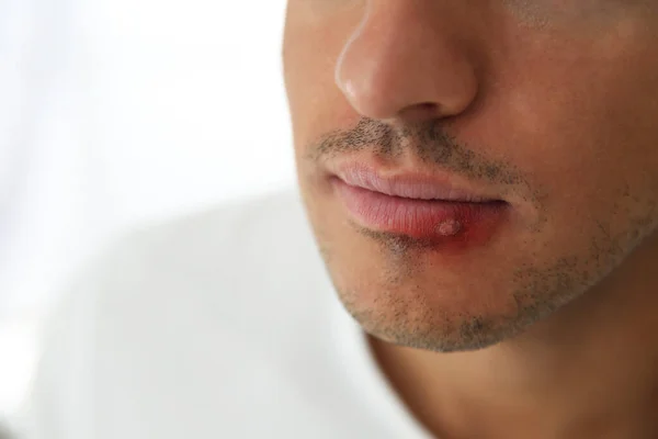 Mann Mit Herpes Auf Der Lippe Vor Hellem Hintergrund Nahaufnahme — Stockfoto