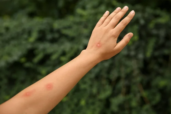 Γυναίκα Τσιμπήματα Εντόμων Στο Χέρι Στο Πάρκο Κοντινό Πλάνο — Φωτογραφία Αρχείου