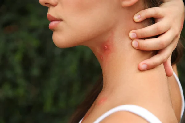 在公园里被昆虫咬伤脖子的女人 特写镜头 — 图库照片