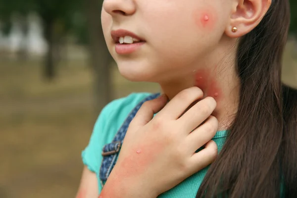 Chica Rascarse Cuello Con Picaduras Insectos Parque Primer Plano —  Fotos de Stock