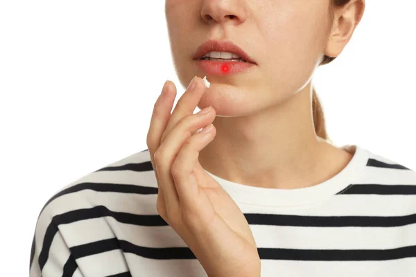 Donna Con Herpes Applicare Crema Sul Labbro Sfondo Bianco Primo — Foto Stock