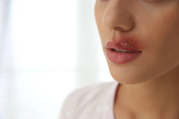 Donna Con Herpes Sul Labbro Sullo Sfondo Chiaro Primo Piano — Foto Stock