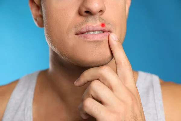 Άνδρας Έρπη Αγγίζοντας Χείλη Κατά Ανοιχτό Μπλε Φόντο Closeup — Φωτογραφία Αρχείου