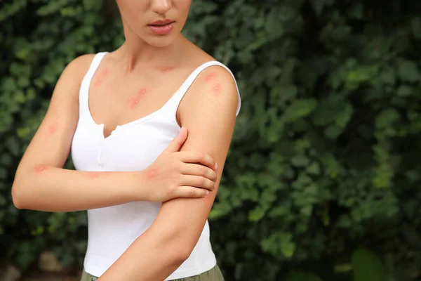 Kvinde Kradse Arm Med Insektbid Parken Closeup Plads Til Tekst - Stock-foto