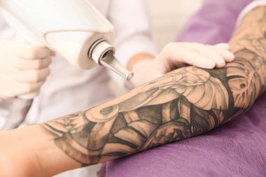 Salonda lazer dövme silme işlemi geçiren genç bir kadın, yakın plan.