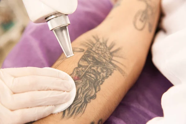 Young Man Undergoing Laser Tattoo Removal Procedure Salon Closeup — Stock Photo, Image