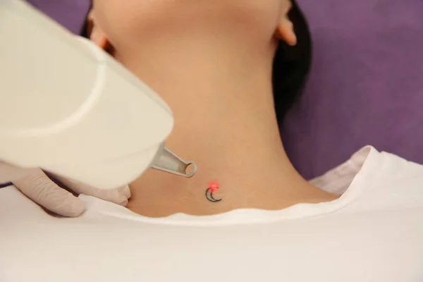 Mujer Joven Sometida Procedimiento Eliminación Tatuajes Láser Salón Vista Superior — Foto de Stock