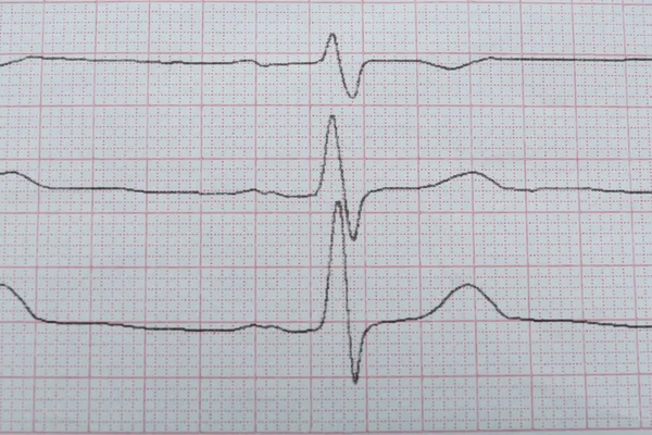 Καρδιογράφημα Έκθεση Φόντο Closeup Διάγνωση Καρδιάς — Φωτογραφία Αρχείου