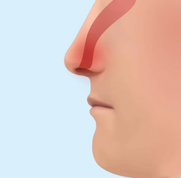 Plakat Reklamowy Aerozolu Nosa Ilustracja Osoby Skupienie Nosie — Zdjęcie stockowe