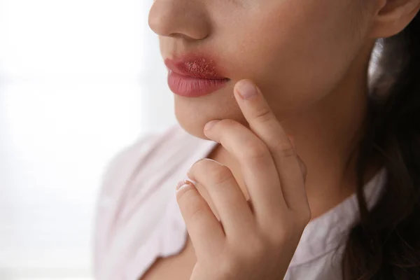 Γυναίκα Έρπη Αγγίζοντας Χείλη Κατά Φως Φόντο Closeup — Φωτογραφία Αρχείου