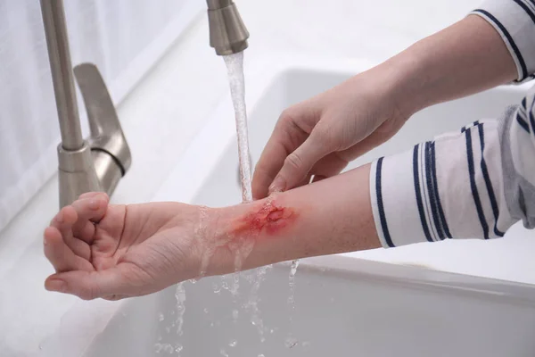 Woman holding forearm with burn under flowing water indoors, closeup