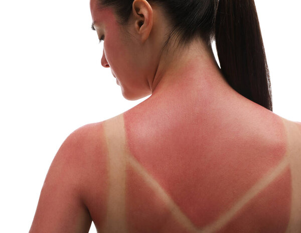 Woman with sunburned skin on white background, closeup