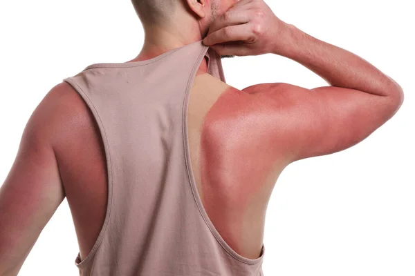 Hombre Con Piel Quemada Por Sol Sobre Fondo Blanco Primer — Foto de Stock