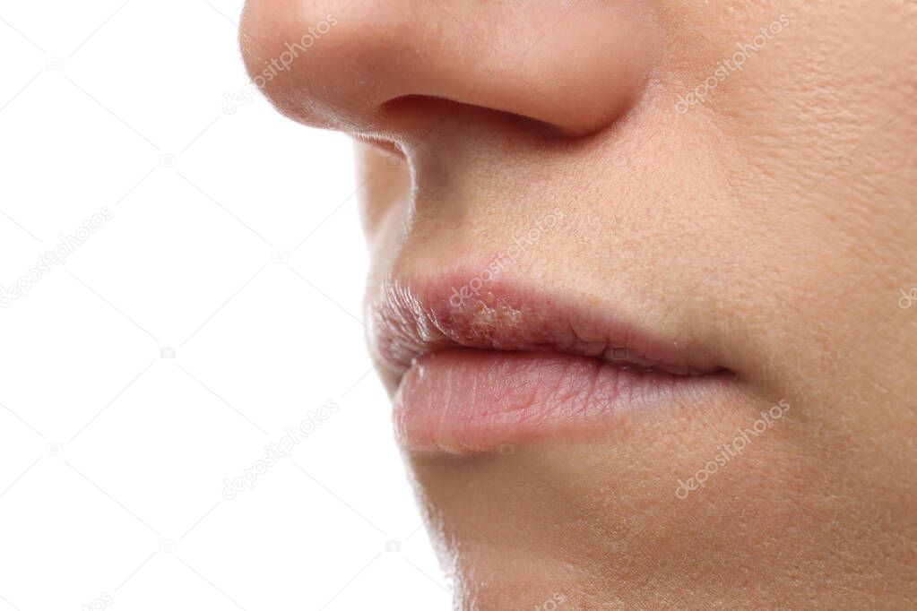 Woman suffering from herpes on white background, closeup