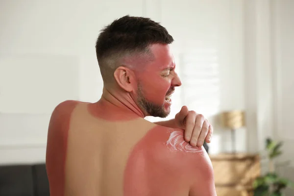 Hombre Aplicando Crema Sobre Quemaduras Solares Casa Vista Trasera — Foto de Stock