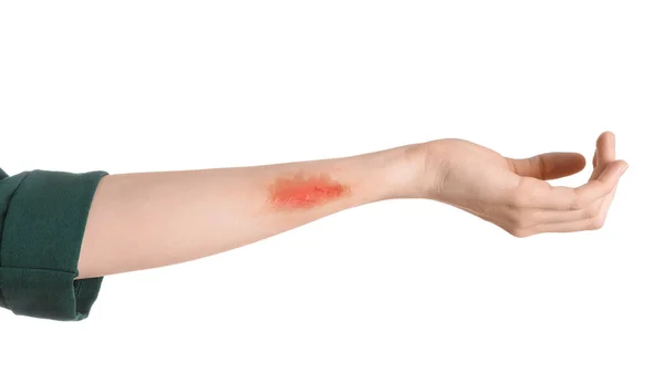 Kobieta Poparzoną Ręką Białym Tle Zbliżenie — Zdjęcie stockowe