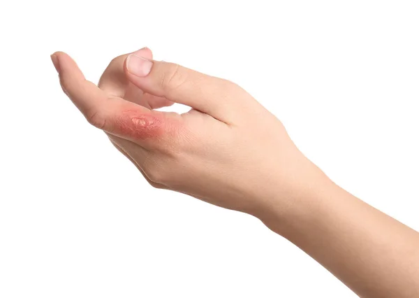 Woman Burn Her Hand White Background Closeup — Stock Photo, Image