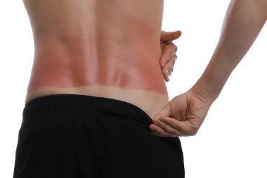 Beyaz arka planda güneş yanığı olan adam, yakın plan.