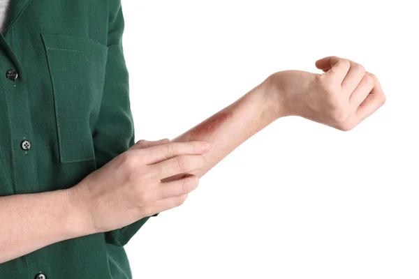 Woman Burned Hand White Background Closeup — Stock Photo, Image