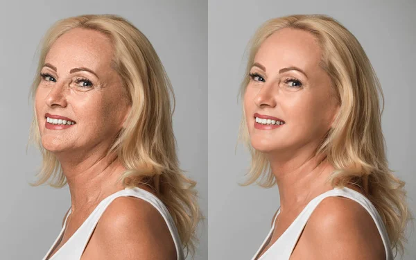Mooie Volwassen Vrouw Voor Cosmetische Ingreep Lichtgrijze Achtergrond Collage Plastische — Stockfoto