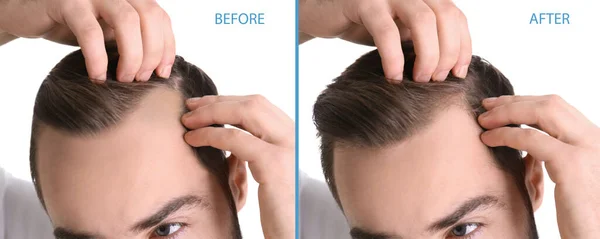 Крупним Планом Вид Чоловіка Після Лікування Випадіння Волосся Білому Тлі — стокове фото