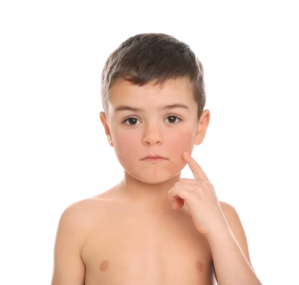 Χαριτωμένο Μικρό Αγόρι Συμπτώματα Αλλεργίας Στα Μάγουλα Λευκό Φόντο — Φωτογραφία Αρχείου