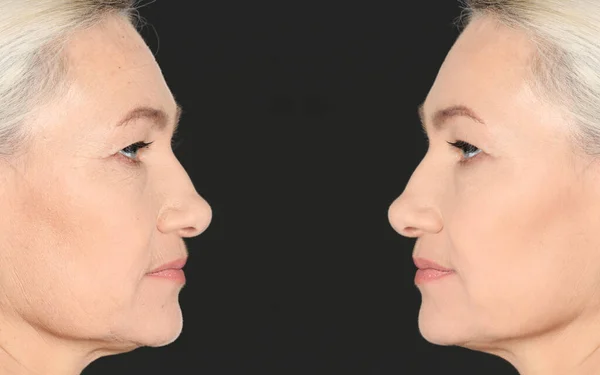 Wanita Dewasa Cantik Sebelum Dan Setelah Prosedur Kosmetik Latar Belakang — Stok Foto