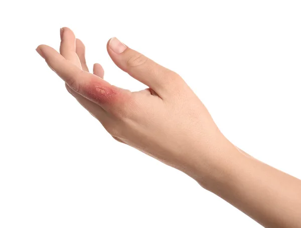 Woman Burn Her Hand White Background Closeup — Stock Photo, Image