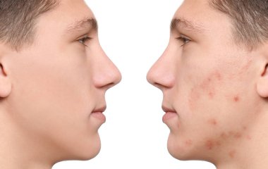 Beyaz arka planda tedavi öncesi ve sonrası sivilceli gençlerin fotoğraflarıyla kolaj.